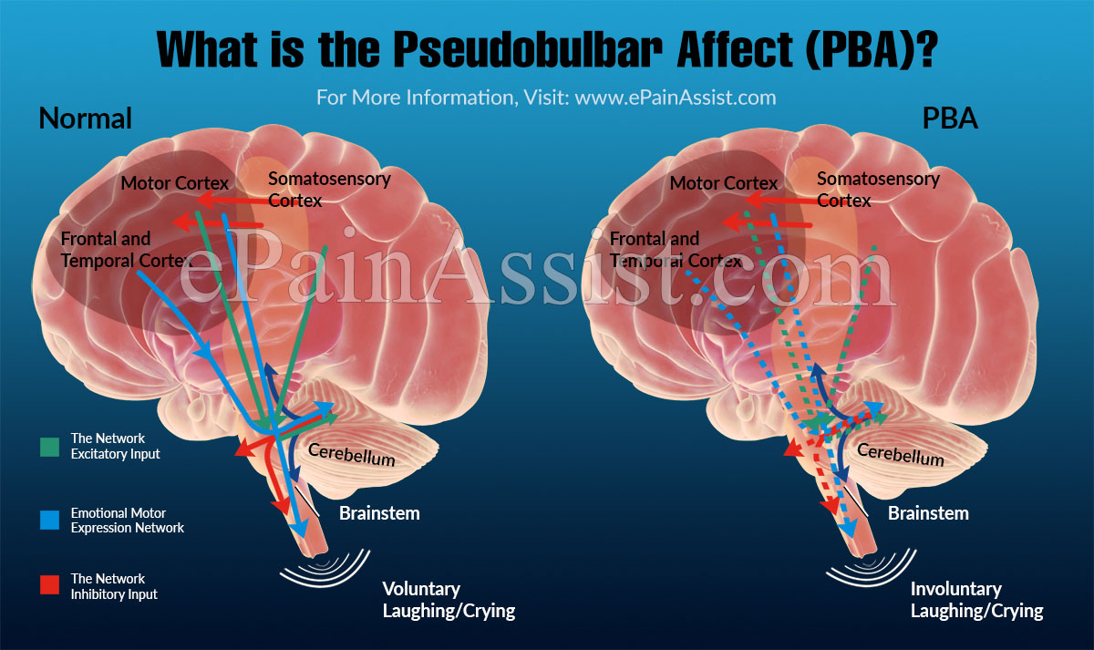Icd 10 Pseudobulbar Affect