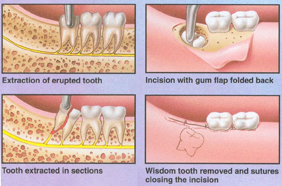 When Did Wisdom Teeth Removal Become Common