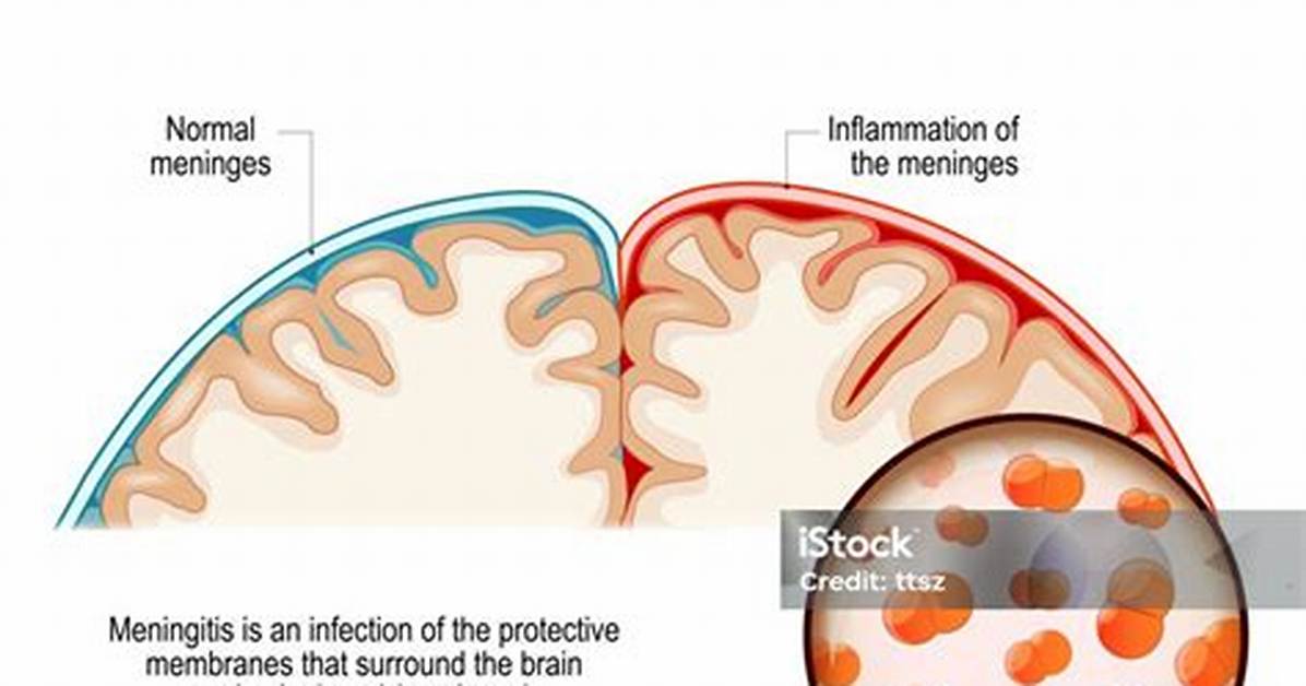 Meningitis In