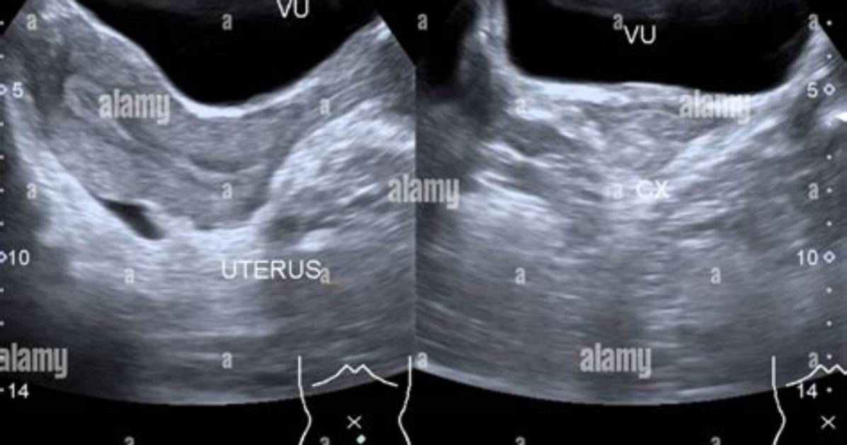 Normal Ultrasound Of